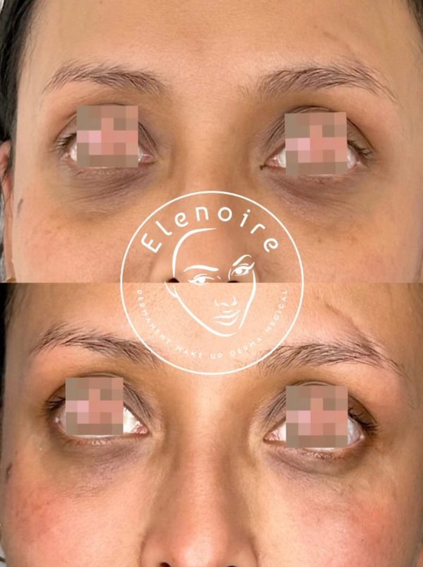 Close-up of a person's under-eye area before and after tear trough dermal filler treatment, highlighting reduced dark circles and added volume for a refreshed and youthful appearance. Results are instant and natural-looking.