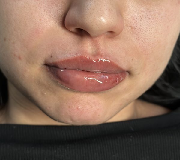 Lip Filler