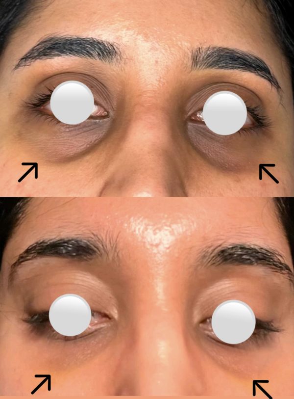 Close-up of a person's under-eye area before and after tear trough dermal filler treatment, highlighting reduced dark circles and added volume for a refreshed and youthful appearance. Results are instant and natural-looking.