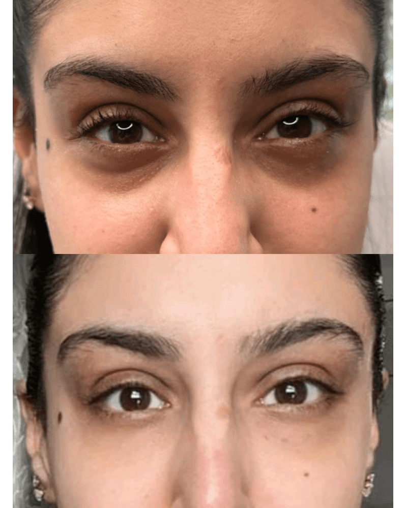 Before and after results of Jalupro Skin Booster treatment for anti-ageing and skin brightening.