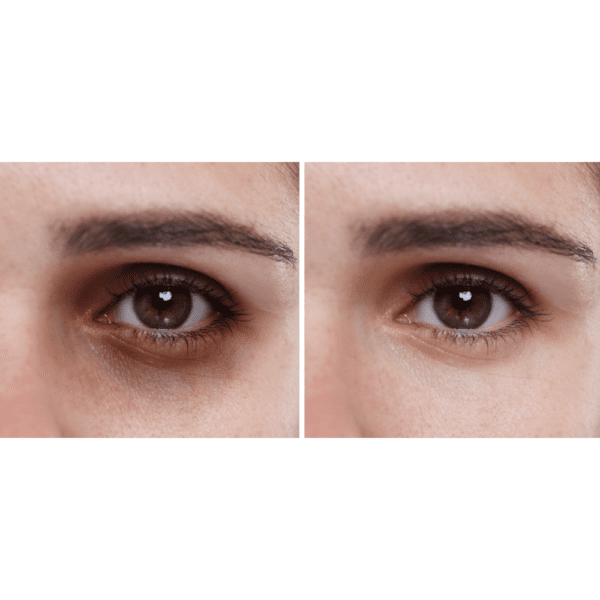 Before and after results of Jalupro Skin Booster treatment for anti-ageing and skin brightening