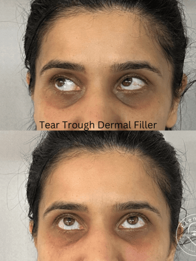 Tear trough dermal filler