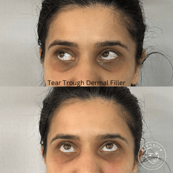 Tear trough dermal filler