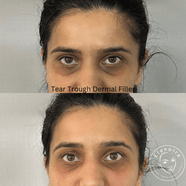 Tear trough dermal filler