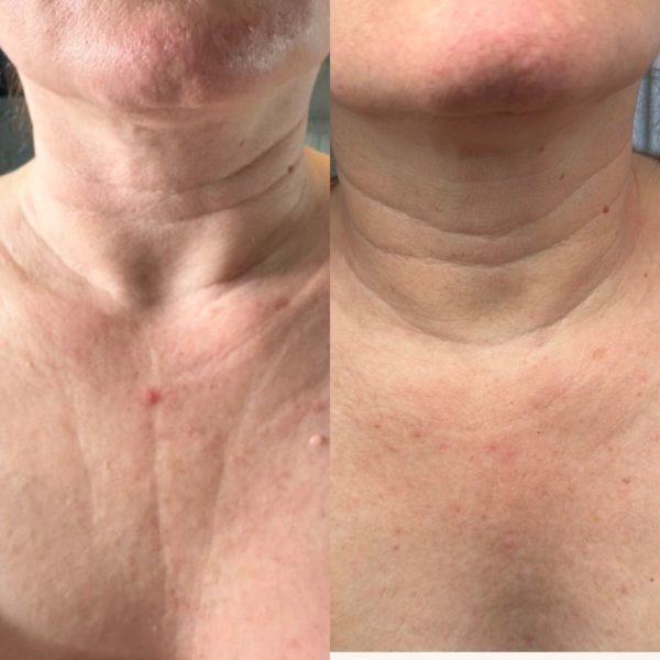 jalupro neck chest