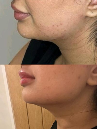 lemon bottle chin jaw treatment