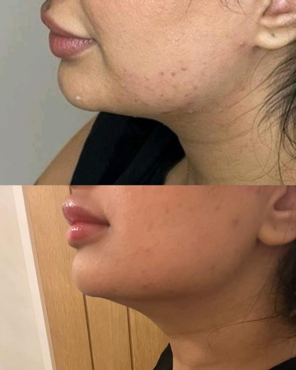 lemon bottle chin jaw treatment