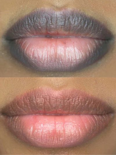 lips neutralisation