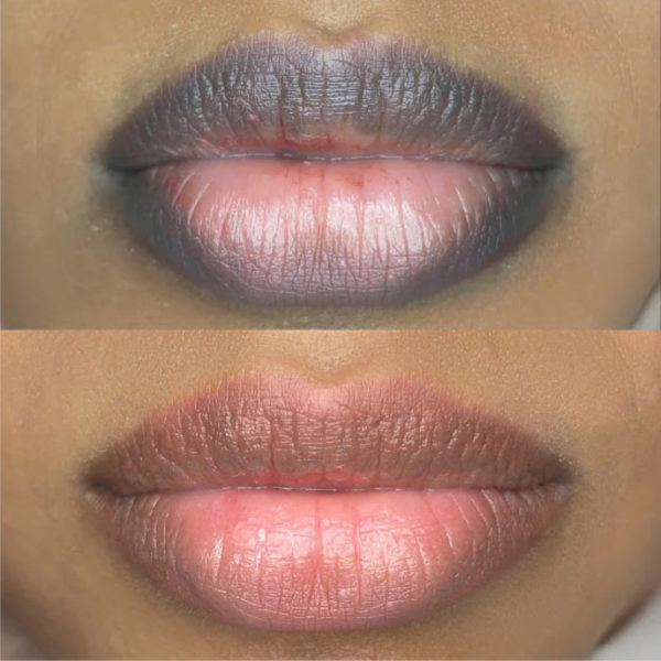 lips neutralisation