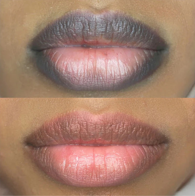 lips neutralisation