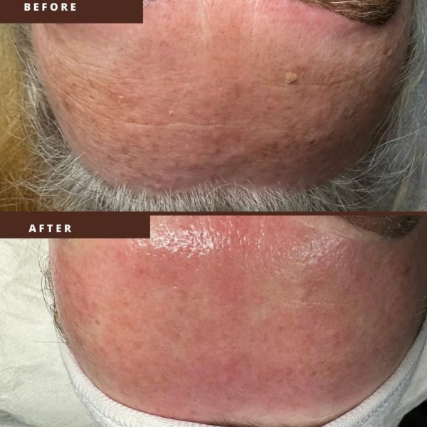 microneedling biorepeel before after