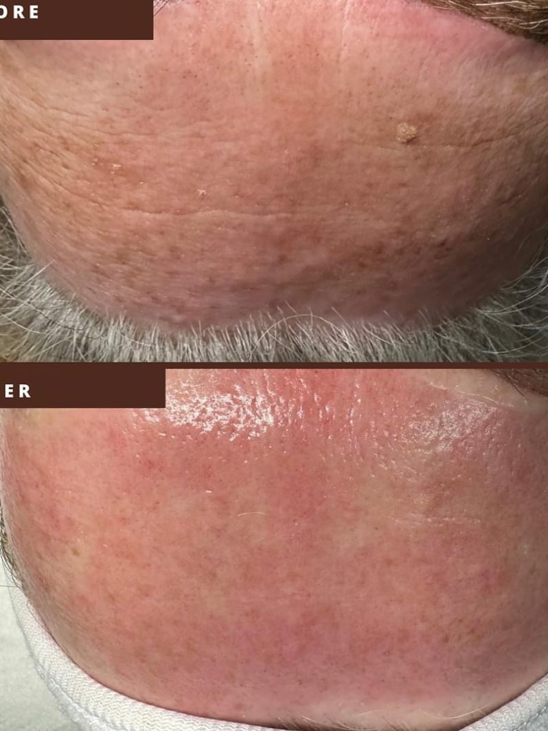 microneedling biorepeel before after