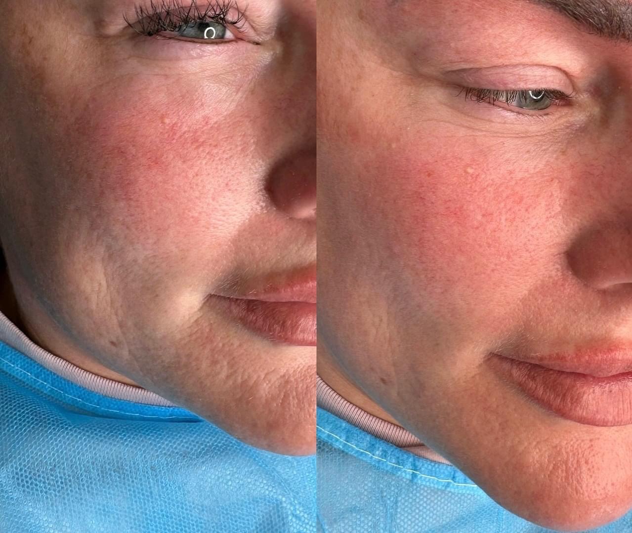 Microneedling with Biorepeel