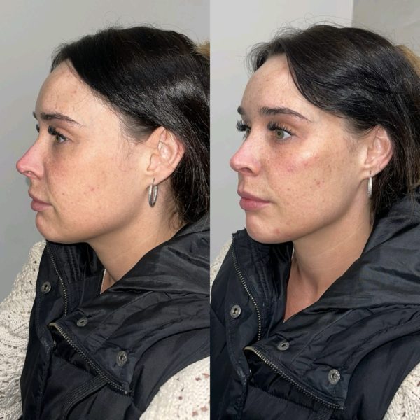 Dermal Fillers