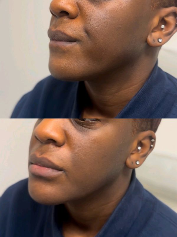 Chin and Jaw Filler