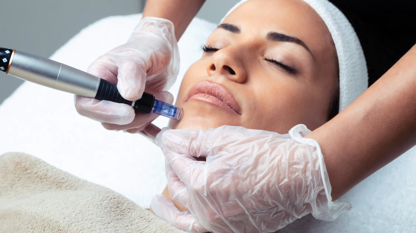 Microneedling Results: How Long Until You See Smoother, Glowing Skin? Aesthetic practitioner performing a microneedling treatment at Elenoire in Birmingham, improving skin texture and collagen production.