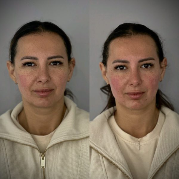 profhilo skin booster