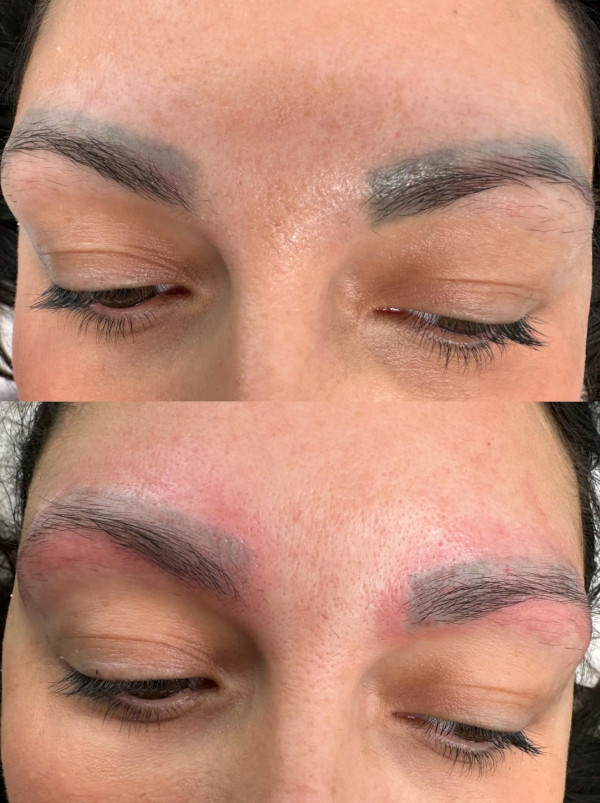 saline-removal-technique