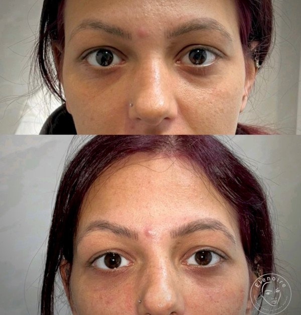 tear-trough-treatment